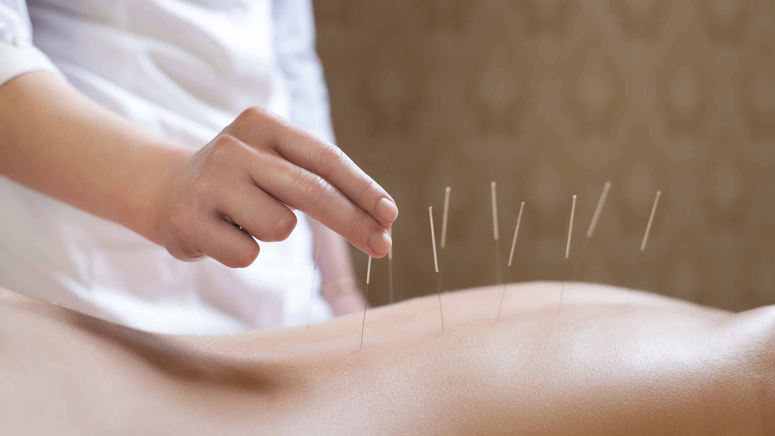 acupuncture-2